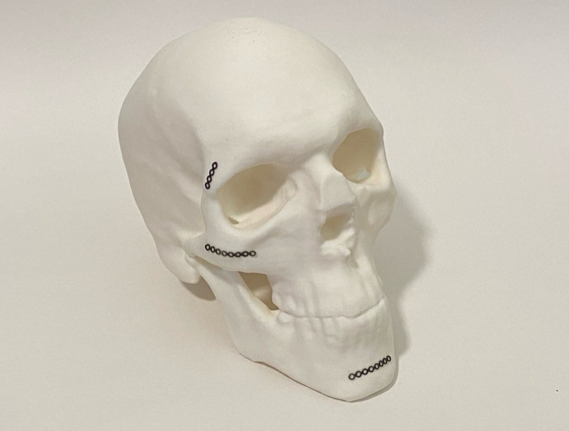 A 3D print of a human skull with three custom-bent fixation plates.