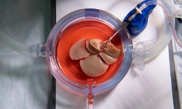 A rat liver being injected with cryoprotective agents.