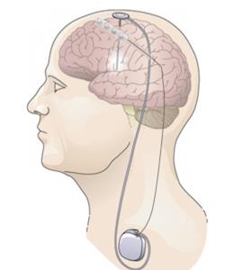 Implanted Activa platform for testing CNT's closed-loop co-adaptation protocols in humans. Closed-loop ECoG sensing and Deep Brain Stimulation permit testing of co-adaptation algorithms in human parti